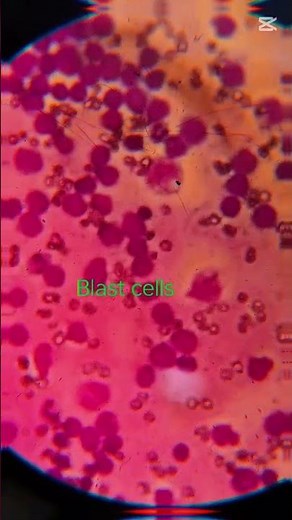 Microscopic view of Blood Cancer 😱 ##Stain : Giemsa, Wright