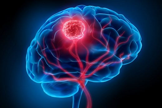 A Guide to Preclinical Models of Brain Metastases