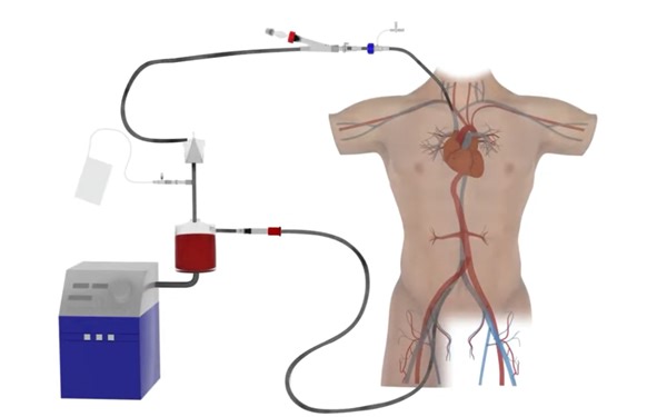 AngioDynamics公司的AlphaVac静脉取栓系统