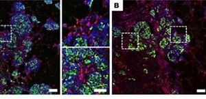4.2K views · 84 reactions | Cystic fibrosis-related diabetes is caused by islet loss and inflammation and not by intrinsic islet dysfunction from CFTR mutation https://insight.jci.org/articles/view/98240 | Journal of Clinical Investigation | Facebook