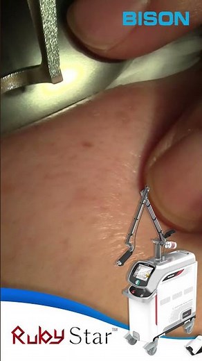 [BISON MEDICAL] RUBY STAR TREATMENT