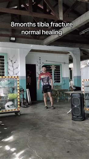 #viral #tibiafracture #tibia #fracture #fyp