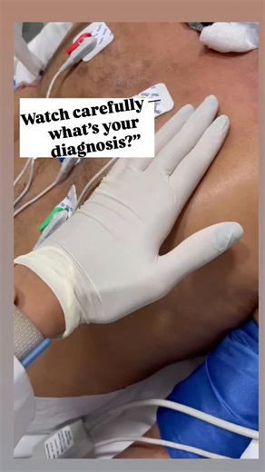 Muneer Jan on Instagram: "Subcutaneous Emphysema Air escapes from the lungs or airways and gets trapped under the skin — producing that “crackling” feel (like bubble wrap). It’s often linked to chest trauma, pneumothorax, or difficult intubation. Early recognition is key to prevent complications. #SubcutaneousEmphysema #AirLeakSyndrome #ChestDrain #TraumaCare #Anesthesia #CriticalCare #MedicalReels #MedEd #EmergencyMedicine #DoctorLife"