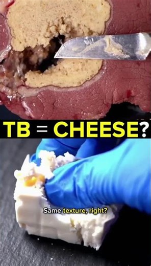 The "Gross" Angle: Why Your Lungs Can Turn into CHEESE 🧀🤢 #shorts