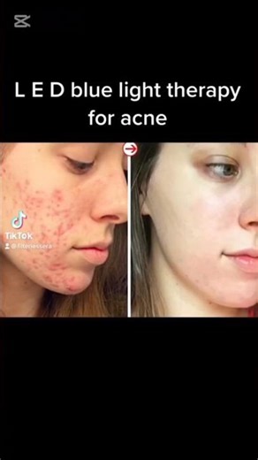 This LED Face Mask is literally changing my skin! 💆‍♀️✨”