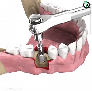 392K views · 637 reactions | Step by step dental implant surgery Credit: SIC invent sic-invent.com | Extreme Machines | Facebook