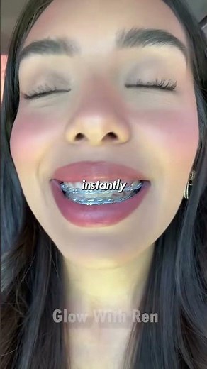 Best Braces Colors 😁 Make Your Teeth Look Whiter Instantly!