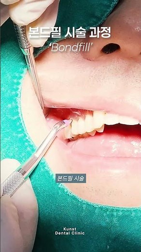 치과 치료 본드필 시술 과정