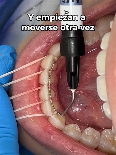 Mantén Tu Sonrisa: La Importancia del Retenedor Dental