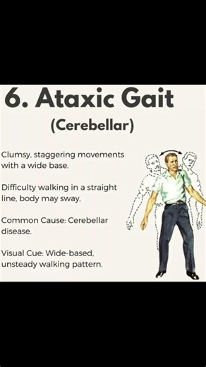 Types of Abnormal Gait (part02)#physiotherapist#painrehabb#abnormalwalk#physiohub