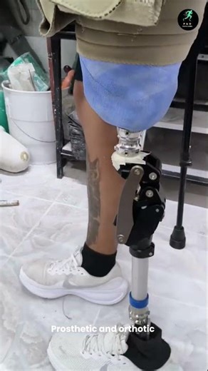 She’s Walking, Smiling, Living | First Practice with Her New Artificial Leg #ProstheticJourney