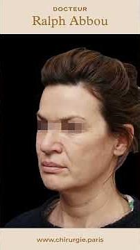 Avant/après lifting du visage par fils tenseurs permanents - Dr Abbou