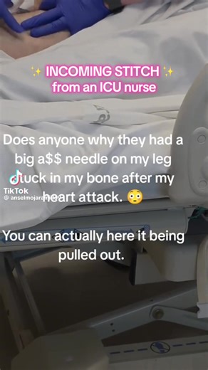 Stitch with: @Anselmo When seconds matter and IV access isn’t happening, IO access gives you rapid, reliable vascular access through the bone marrow. 🦴 When to use it: Cardiac arrest, shock, trauma, sepsis—any time IV access is delayed or unsuccessful. 💉 What can go through an IO? Fluids, blood products, and all emergency meds. IO = IV equivalent in resuscitation. 📍 Common sites: Proximal tibia, distal tibia, proximal humerus (great flow rates in adults). ⚠️ Key nursing considerations: • Land
