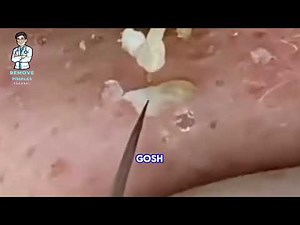 Explosive Extractions: The Ultimate Pimple Popping Showdown!
