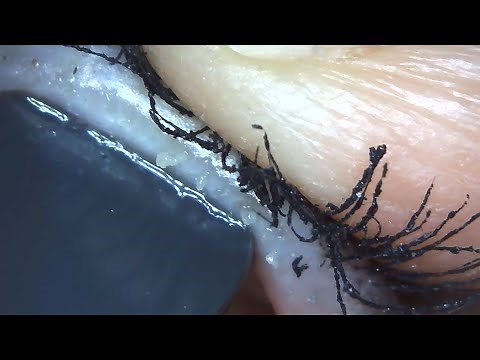 Pus Clogged Oil Glands in eyelids!