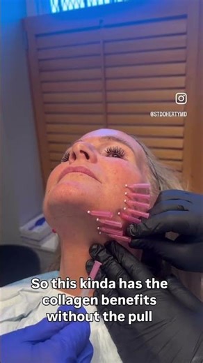 Is a PDO mono thread procedure worth it? Board Certified Plastic Surgeon Sean Doherty