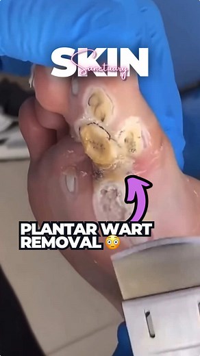 Plantar Wart Removal: Causes, Treatment, and Prevention Tips