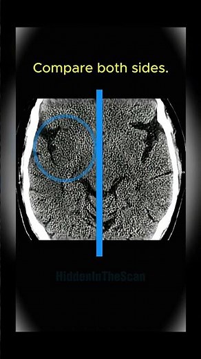 Acute brain ischemia