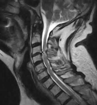 Cervical canal stenosis and spinal cord atrophy