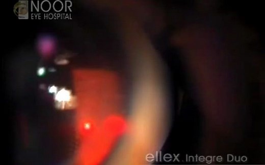 【全视网膜激光光凝术PRP】Pan Retinal Photocoagulation to Treat Diabetic Retinopathy