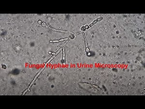 Fungal Hyphae in Urine Microscopy