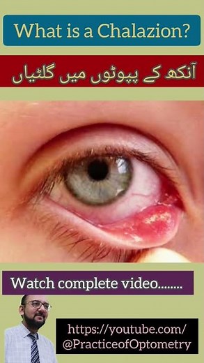 Chalazion | Meibomian Cyst | Eyelid Cyst | Practice Of Optometry | Eye Exam | Eye Lump | Eye Pain