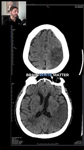 Massive Stroke on CT: Every Finding Explained