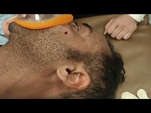 Zygomatic arch fracture reduced under sedation by Dr. Mohamed Elshamaa