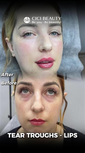 Tear Trough Filler: Brighten Your Eyes in Vietnam