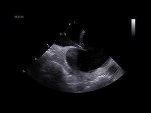 Fluoroless ICE Guided Transeptal Puncture