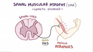 Video: Spinal muscular atrophy - Video Explanation! | Osmosis | Osmosis
