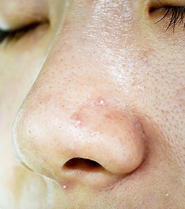 Whiteheads On Nose: 5 Prevention Tips & Treatment Options