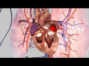 Atrial Fibrillation Animation