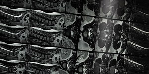 Experimental Cancer Drug Regrows Nerves in Spinal Cord Injury | Drug Discovery And Development