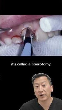 Orthodontic Relapse? You Can Prevent It w/ Fiberotomy #periodontist #orthodontics #invisalign