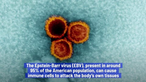 Scientists Say Epstein-Barr Virus May Trigger Lupus Disease