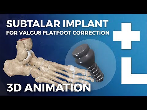 Subtalar implant procedure (arthroereisis) - flexible flatfoot surgery animation - Dworska hospital®