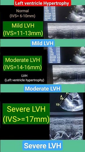 LVH ( Left ventricle Hypertrophy) l Mild, moderate,severe LVH l #echo #lvh #shorts