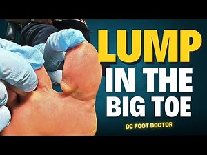 Lump In The Big Toe