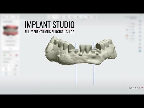 3shape Implant Studio Fully Edentulous