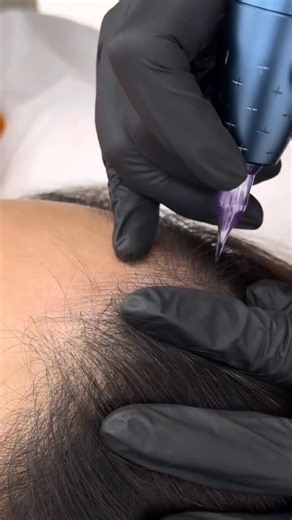 PMU Supply Shop - Penny Peng on Instagram: "SMP Hairstroke via Mast Needle and Famisoo Machine #scalp #permanentmakeup #pmu #spmu #pmuscalp #brows #permanentmakeupartist #permanentmakeupbrows #pmuartist #spmuartist #scalpmicropigmentation #scalptreatment #scalptattoo #scalptattooing #spmubrows #pmusupplyshop #pmubrows"