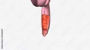 Pouchitis is inflammation that occurs in the lining of a pouch created during surgery to treat ulcerative colitis or certain other diseases.