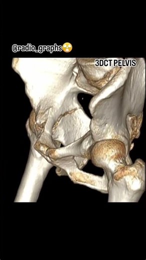 ct pelvis #anatomy #ctscan #xray #doctor #nurse #viral #tranding #mri #science #student #study #xray