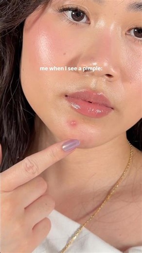 All I need is a pimple patch + makeup and I’m good to go 😂👏🏼 #acneproneskin #makeup