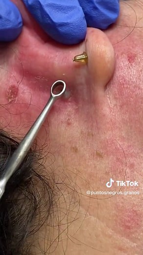 Tratamiento Eficaz para Puntos Negros y Espinillas