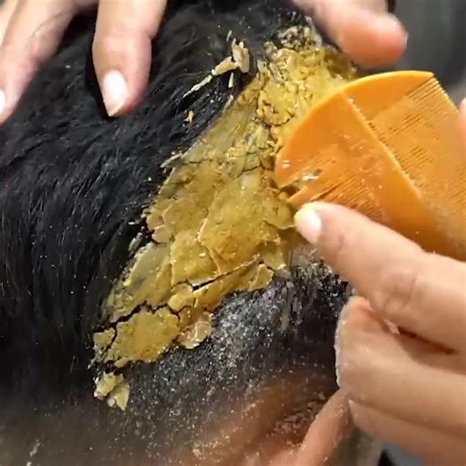 114K views · 192 reactions | Ah Ha Worm Hole Flakes So Big !! Dandruff Removal Itchy Scalp Satisfying #399 Part 7 | Help remove ticks | Facebook
