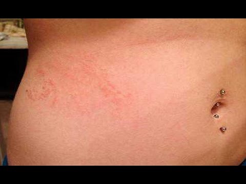 ❄Scabies Rash Images, How To Remove Scabies From Hair, Scabies After Treatment, Scabies Life Cycle