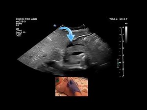 Midgut Volvulus Ultrasound Protocol