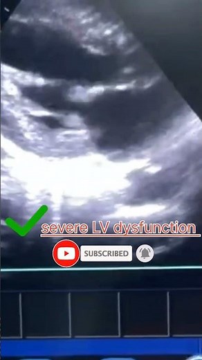 severe LV systolic dysfunction with mild pericardial effusion what EF ejection fraction in echocard