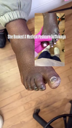 Have you ever heard of someone who transforms toenails? 💅🏽✨ Because that’s exactly what happens when you book a medical pedicure in Chicago with me — where health meets beauty, and confidence starts at your feet. Your toes deserve a second chance. 📍Chicago | Book via link in bio #MedicalPedicure #ToeTransformation #ApologyBabe #ChicagoNailTech #HealthyFeetJourney #ToenailRestoration #FungusCare #NailRehab #FootHealthMatters #ApologyLLC #ConfidenceStartsAtYourFeet #ChicagoBeautyPro | Marilyn R